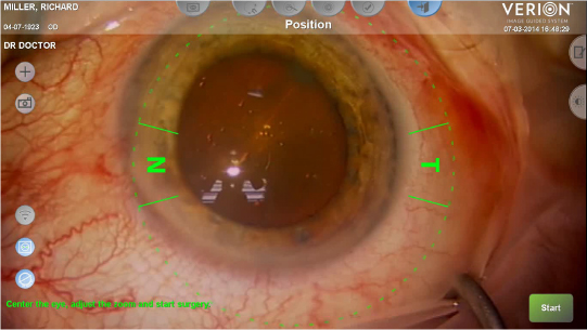 イメージ：手術直前の患眼認識・登録