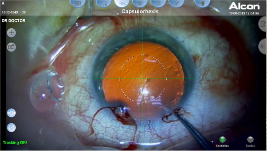 イメージ：Capsulorhexis（嚢切） ガイド