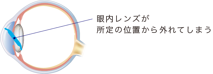 イメージ：眼内レンズの偏位・脱臼
