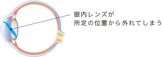 イメージ:眼内レンズの偏位・脱臼