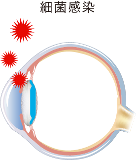 イメージ:術後眼内炎