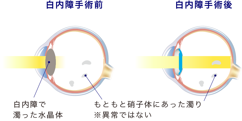イメージ:飛蚊症・硝子体混濁