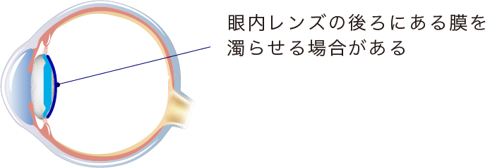 イメージ:後発白内障