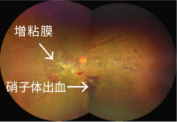 イメージ：硝子体手術前