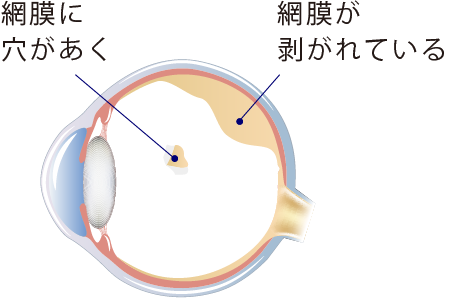 イメージ：網膜剥離